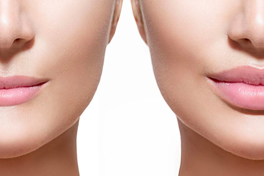 Everything You Need To Know About The Lip Surgery