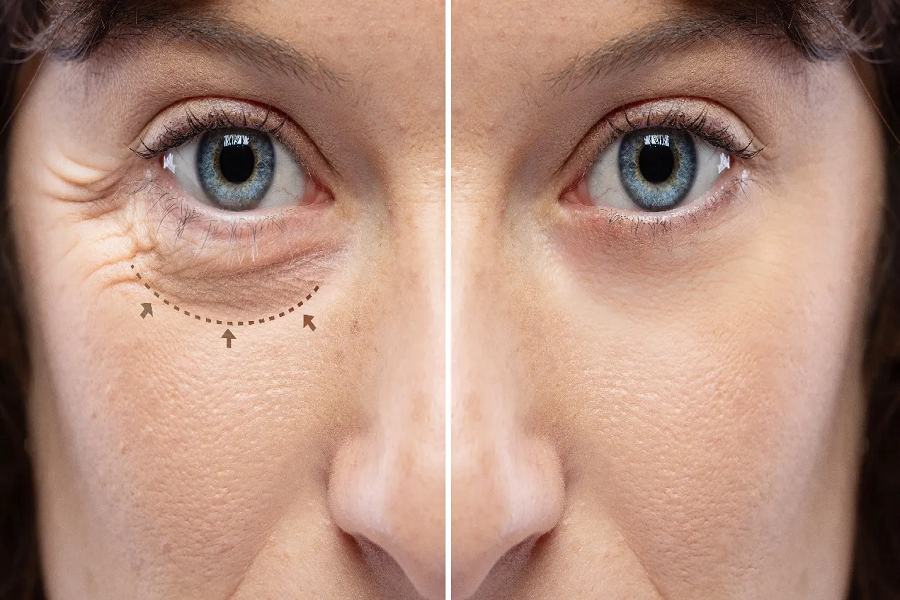 Are You The Right Candidate For Double Eyelid Surgery