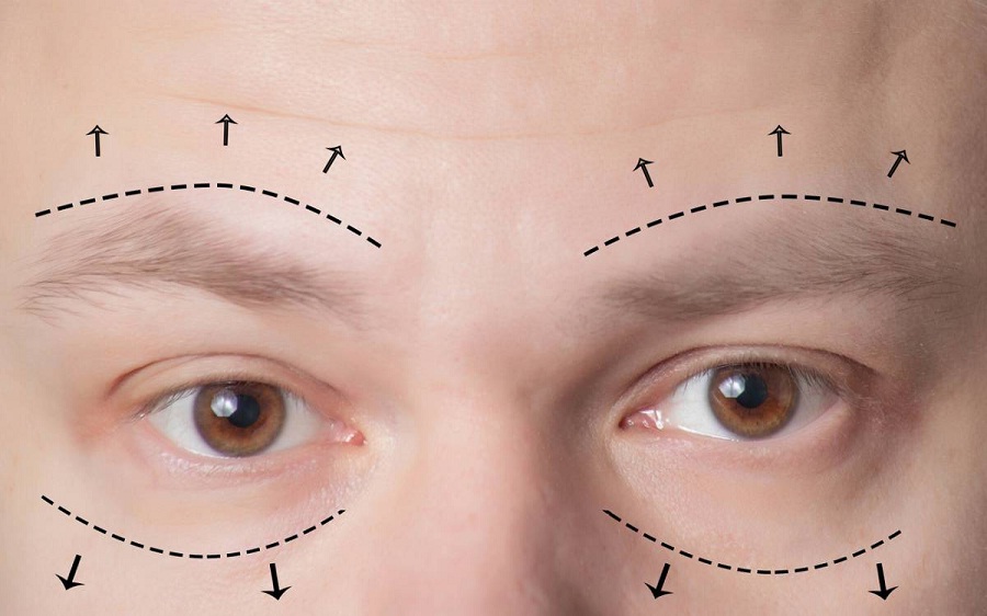 What Are The Different Forms Of Double Eyelid Surgeries?