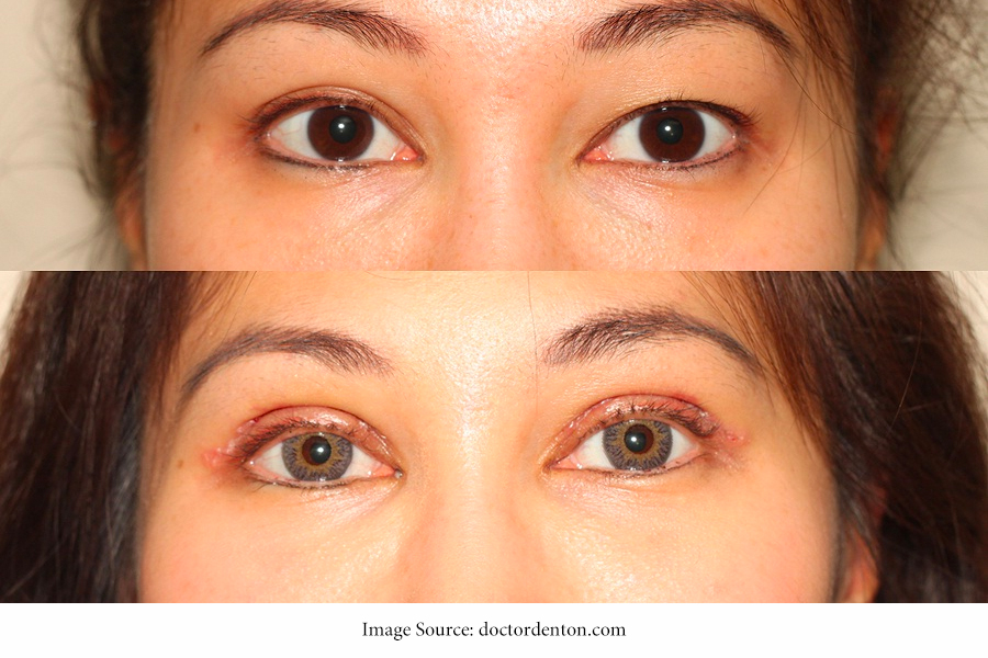 What Is Double Eyelid Surgery